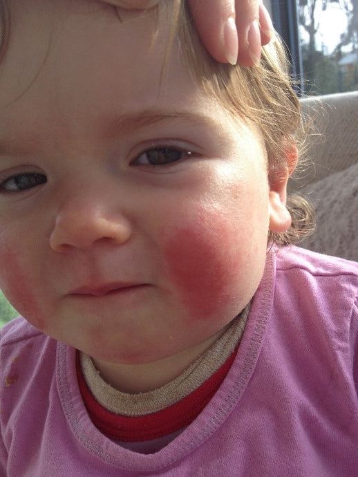 What could be more upsetting than a child thoroughly uncomfortable with itchy, weepy, angry rashes?